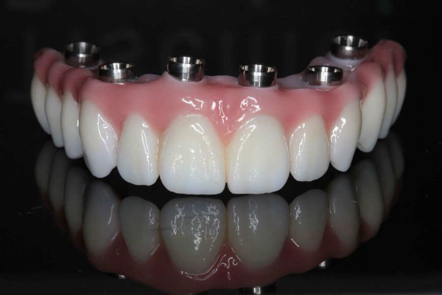 Implants
